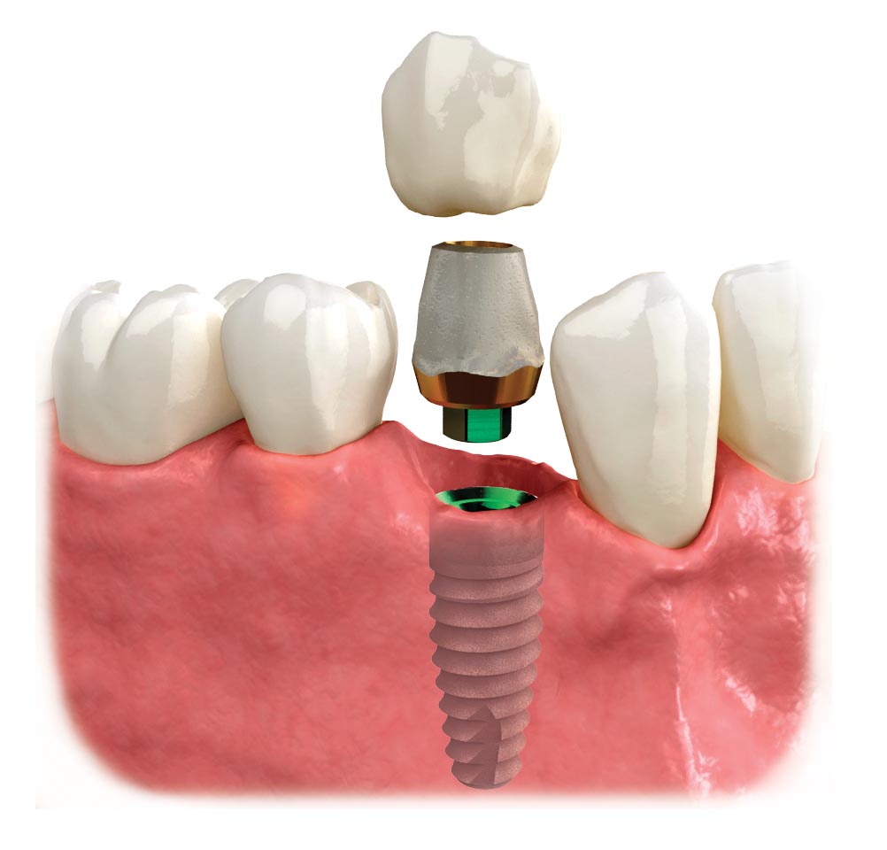 Răng implant tồn tại bao lâu?